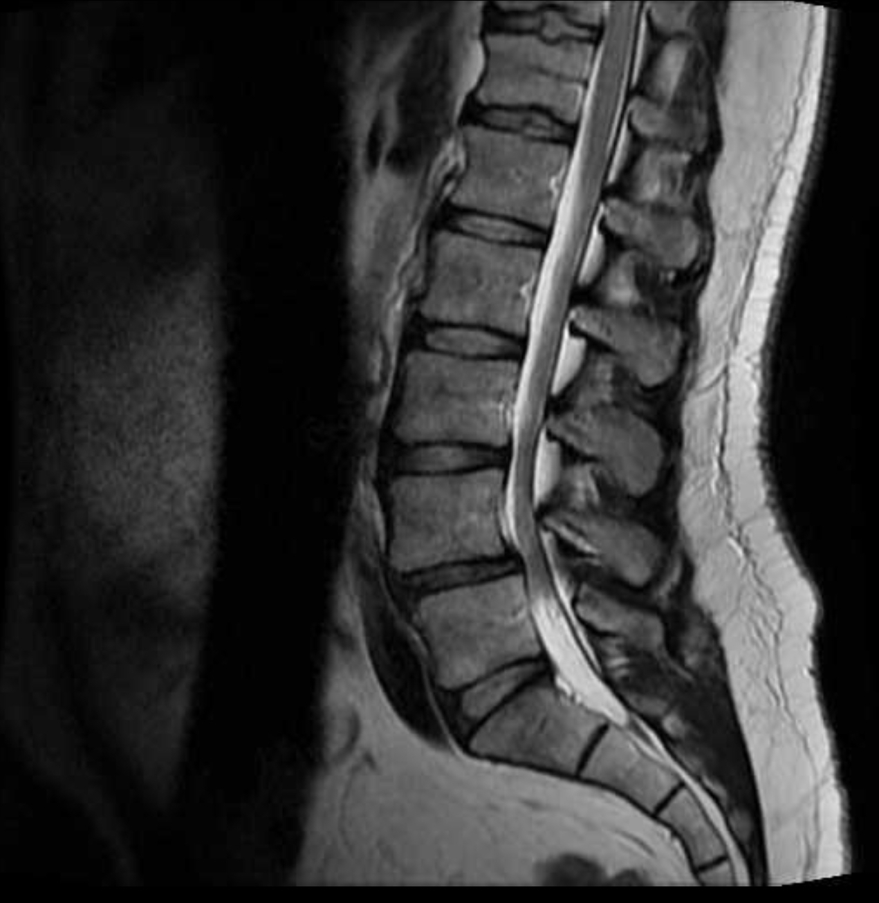 Medical Term Spinal Cord Tumor